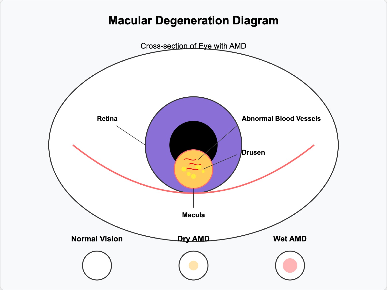 Macular Degeneration Diagram