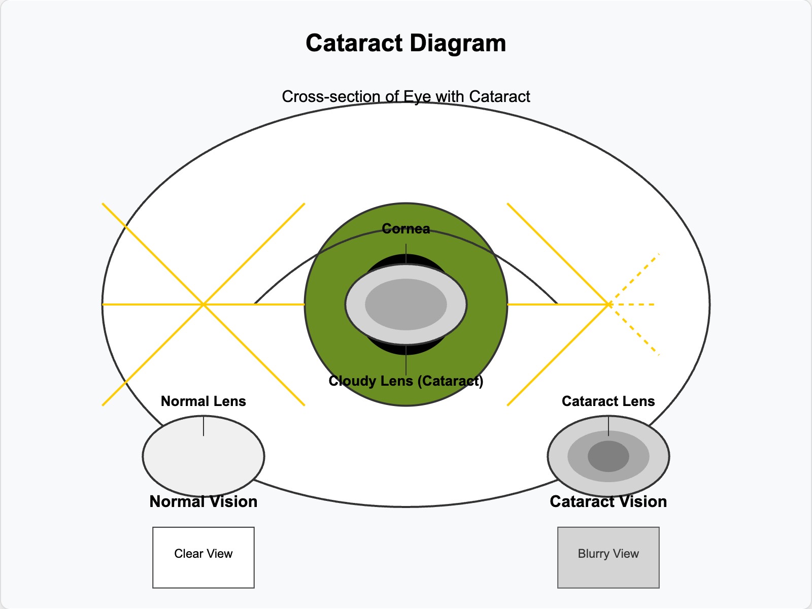 Cataract Diagram
