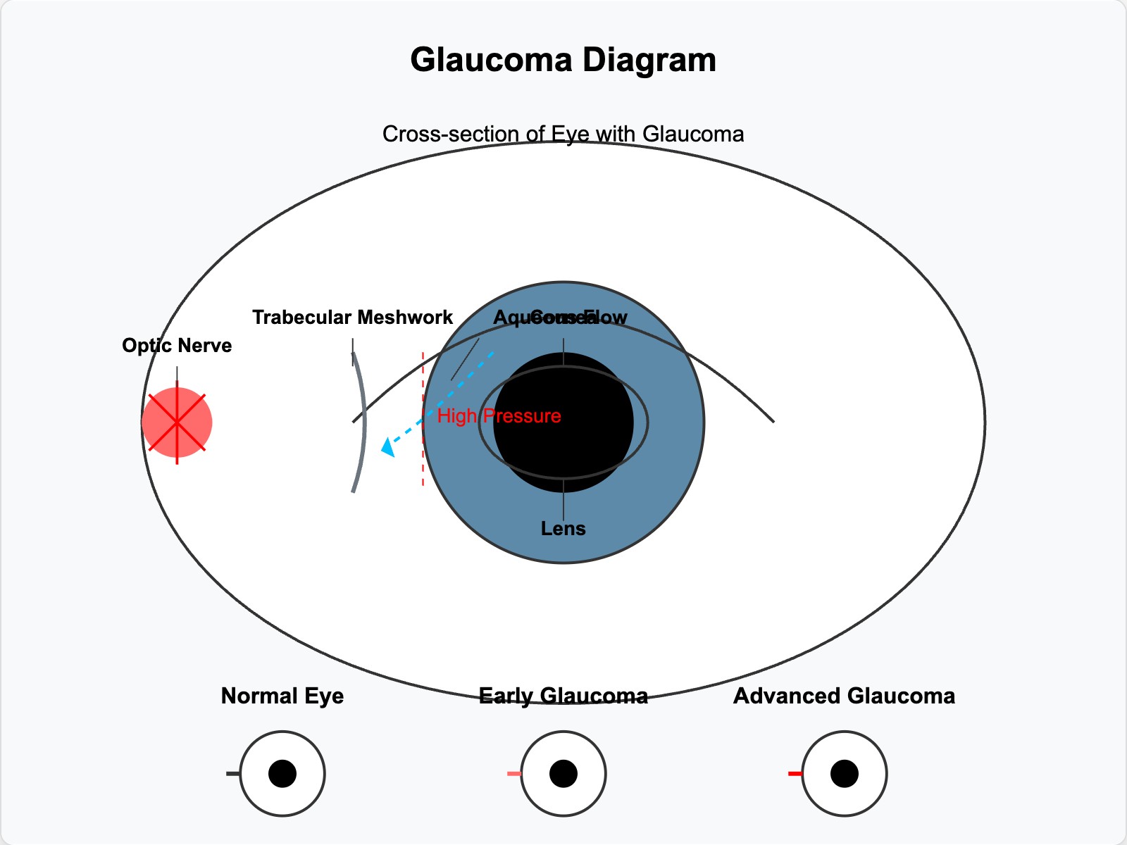 Glaucoma Diagram
